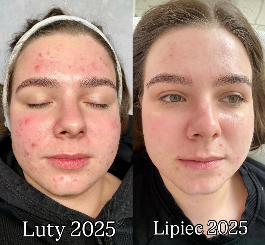 Usuwanie blizn Katowice