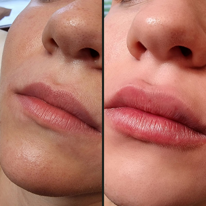 Zabieg przed i po efekty Efekt przed i po zabiegu