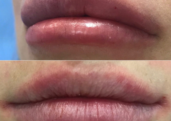 Hialuronidaza Katowice