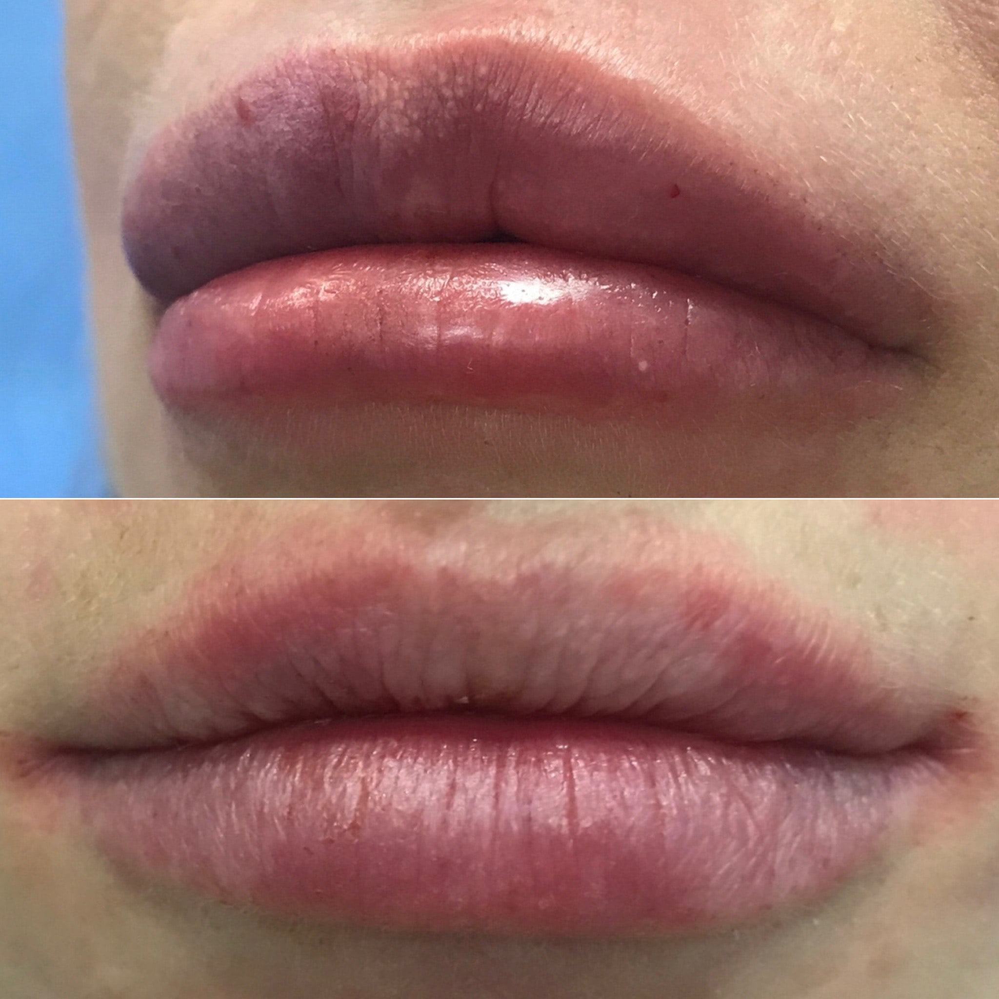 Hialuronidaza Katowice